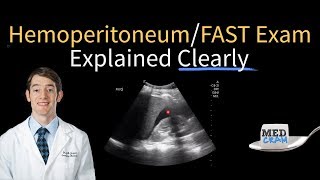 Hemoperitoneum  Free Fluid in the RUQ on Ultrasound  FAST Exam [upl. by Sergei478]