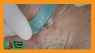 Live Facial Skin Shave Biopsy  Auburn Medical Group [upl. by Ceil]