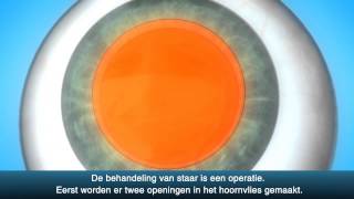 Staaroperatie cataract  OLVG Oogheelkunde [upl. by Mapes923]