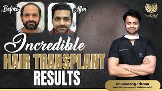 Incredible Hair Transplant Results  9 Month Hair Transplant Results  Medlinks [upl. by Aneema]