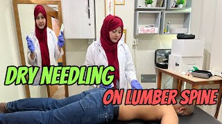 Applying Dry Needling for Lower Back Pain  lowerbackpain accupuncture PhysiofitByDrMajid [upl. by Wald106]