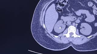 Renal ureteric stone hydronephrosis and renal swelling CT findings [upl. by Brant]