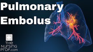 Pulmonary Embolus Nursing Care [upl. by Kyriako13]