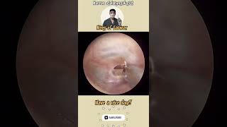 고막염증제거 otitismedia needle aspiration satisfyingvideo ENT [upl. by Ainna801]