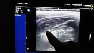 Subhepatic Appendix Sonography [upl. by Airotel301]