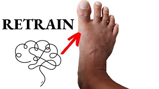 Get Rid Of Bunions For Good Nervous System Retraining [upl. by Viole]