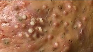 blackhead removal  acne removal  with spa day everydayEp006 [upl. by Cordier]