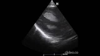 Isolated asymptomatic fetal intracardiac mass  Supplementary video ID 402663 [upl. by Allehcram486]