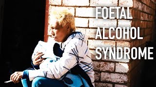 A Look at Foetal Alcohol Syndrome [upl. by Acinorav457]