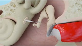 Stapedotomy Animation to Treat Otosclerosis Curable Type of Hearing Loss [upl. by Aham]