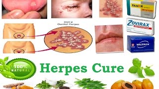 Herpes Cure  How To Get Rid Of Herpes [upl. by Segroeg]