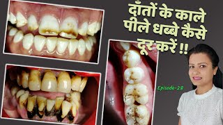 black spots on teeth how to remove home remedies  दांतों की सफाई Episode 28 [upl. by Anirtik810]