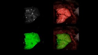 Intraoperative Subpleural Lung Tumor Margin Visualization Using Indocyanine Green Inhalation [upl. by Keven612]