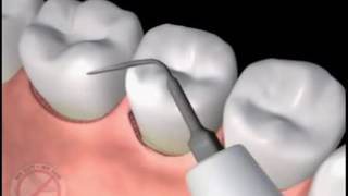 Tratament Parodontoza Laser [upl. by Bohannon]