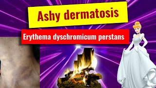 Ashy dermatoses Erythema dyschromicum perstans overview features histology management [upl. by Ludovick262]