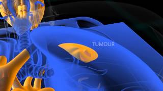 PET Scan animation [upl. by Willumsen]