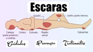 ♿ Como Prevenir e Tratar escaras Pós Lesão Medular [upl. by Rambow]