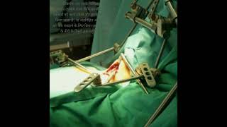 surgical instruments Finochietto retractor  Master classes shorts trending surgical health [upl. by Neelyam568]