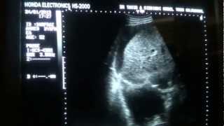 ASCITIC vs PLEURAL FLUID differentiation by ultrasound [upl. by Drud]