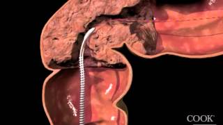 Evolution® Colonic ControlledRelease Stent  Uncovered Endoscopic Animation [upl. by Orgalim]