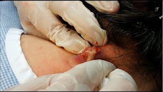 Boil  Cyst Removal Surgery [upl. by Hareema]