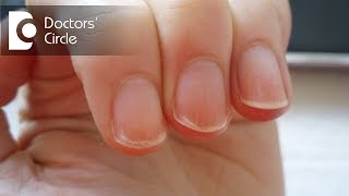 What can cause peeling of nails in an individual  Dr Aruna Prasad [upl. by Gaskins]