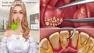 ASMR Cause of bad breath Tonsil Stone Removal Animation [upl. by Bran]