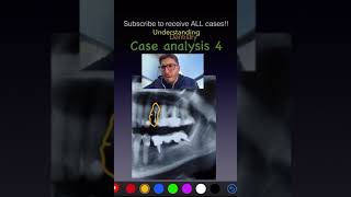 Can you find all alterations Case 4  Dental Quiz dentalstudents dentalimage [upl. by Gasparo789]