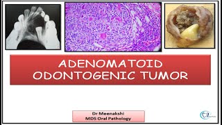 Adenomatoid odontogenic Tumor [upl. by Ecirtram13]