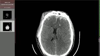 Post traumatic SAH SDH brain edema pneumocephalus [upl. by Eelasor]