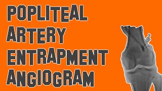 Popliteal Artery Entrapment [upl. by Suisyola]