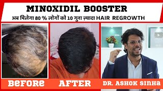 Minoxiboost Minoxidil Booster For Hair Growth  New Hair Research  10x More Result  Hair Loss [upl. by Nnybor124]