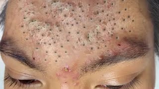 Extreme Blackhead Removal at Nasa Spa  Relax Every Day With Sac Dep Spa 2023 2820 [upl. by Ajssatsan]