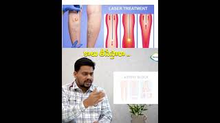 These AreThe Side Effects Of Varicose Veins Glue Treatment  Dr Sampath Vadithya Vascular [upl. by Nagah499]