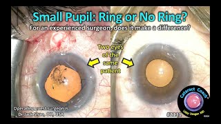 CataractCoach™ 2131 small pupil cataract surgery ring or no ring [upl. by Nylirret245]