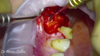 Straumann BLX implant placement and Simultaneous Sinus lift procedure [upl. by Sibeal520]