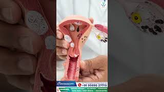 How are Uterine Fibroids Treated NonSurgery  Fibroid Embolization at Avis Hospital [upl. by Esiuolyram46]