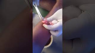 Lipoma removal video [upl. by Alil883]