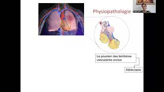 Embolie pulmonaire [upl. by Zoha]