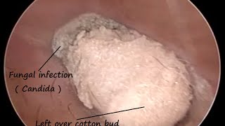 Removal of left over cotton bud  Q Tip   It causes Fungal infection with minute perforations [upl. by Pennington]