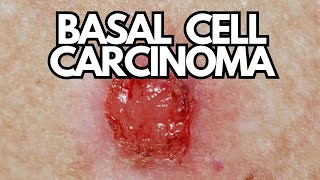 Basal Cell Carcinoma in Seniors [upl. by Papotto751]