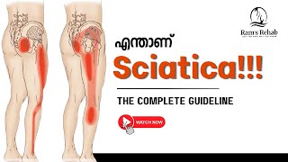 ഇടുപ്പിൽ നിന്ന് ഇറങ്ങി വരുന്ന വേദന sciatica പൂർണമായും മാറുന്നുണ്ടോ  Evidence based Study [upl. by Vlada15]