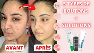 LACNÉ  MA ROUTINE SKINCARE  TOUTES LES SOLUTIONS POUR CHAQUE TYPE DE BOUTON [upl. by Nakah]