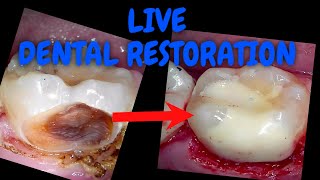 103 Deep Margin Elevation and Massive 37OB with Selective Caries Removal [upl. by Bevus89]