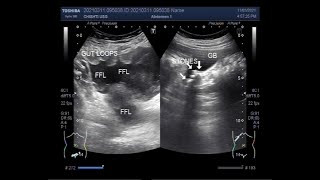 Hemoperitoneum due to Blunt trauma in a traffic accident [upl. by Faun]