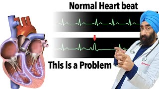 Understand Premature Heart Contraction  Ectopic Beat  PVC  VPC  DrEducation [upl. by Ecyned]