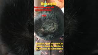 Tinea capitis kerion awarenesshaircarefungalinfectionsdrvaraprasadtineaalopecia childhood [upl. by Aelhsa704]