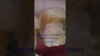 Incrustación OnLay de Zirconia caries salud dientes odontologia estetica [upl. by Dohsar]