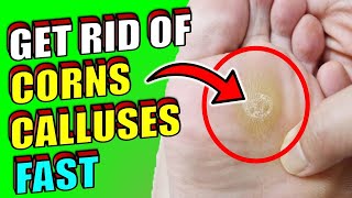 HOW TO GET RID OF CORNS amp CALLUSES ON FEET  FAST amp EFFECTIVE HOME REMEDIES [upl. by Saito]