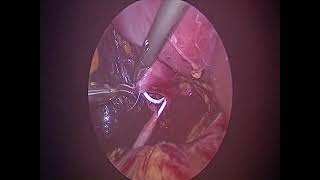 Dr Kerkeni  Laparoscopic pyeloplasty and renal cyst [upl. by Garin]